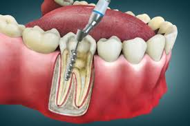 Root canal therapy to treat infected tooth pulp